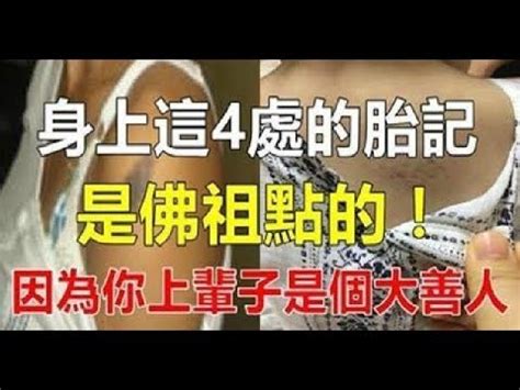 腳底胎記|腳底紅胎記：可能的併發症